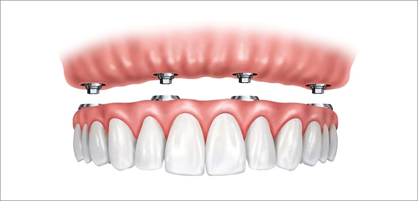 What is a screw retained implant?