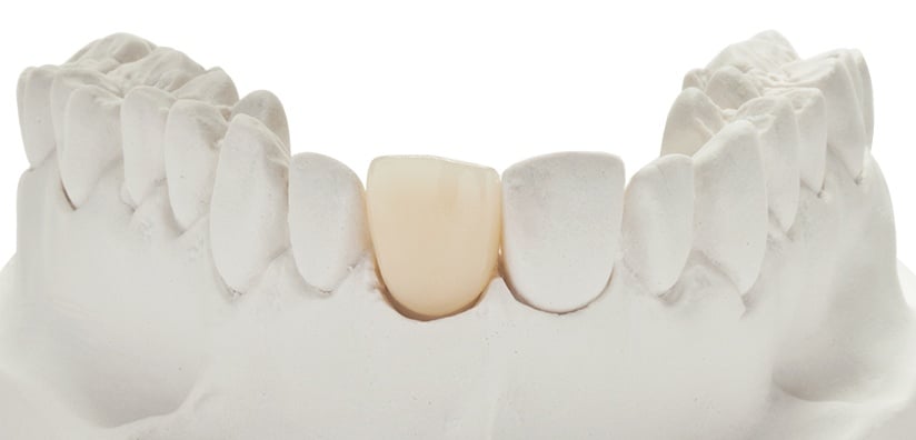 HIGH TRANSLUCENT ZIRCONIA: Benefits, Wear Properties and Selection Process