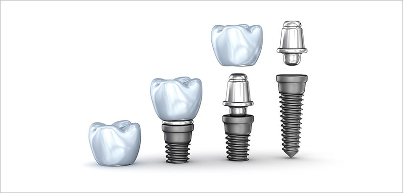 SCREW-RETAINED IMPLANT CROWN