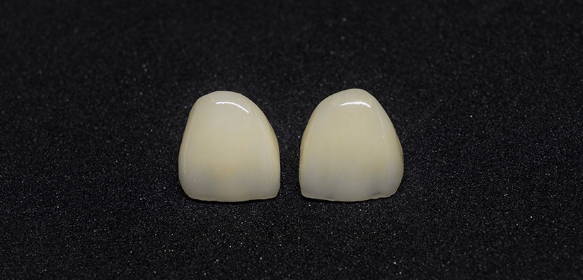 TOOTH PREPARATION FOR ALL CERAMIC CROWNS