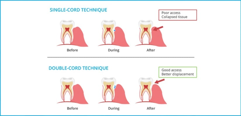 BENEFITS OF THE DOUBLE CORD TECHNIQUE FOR YOUR DENTAL PRACTICE