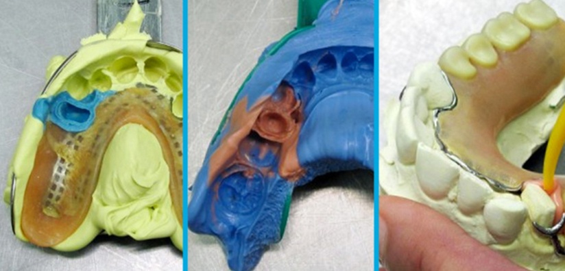 3 TECHNIQUES TO ACHIEVE OPTIMAL RESULTS WHEN PLACING A CROWN UNDER A PARTIAL DENTURE
